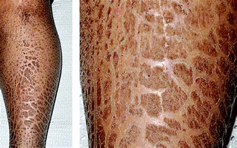 Ten Rare Skin Conditions Explained People Daily