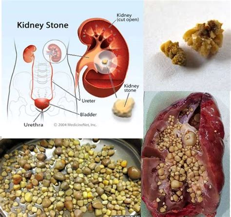 How Can You Pass A Kidney Stone