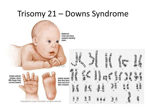 Trisomy 21 Syndrome Pictures