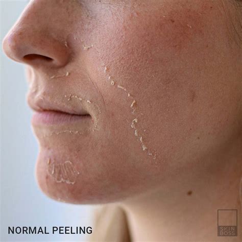 Burn Spots After Chemical Peel Why And When They Happen