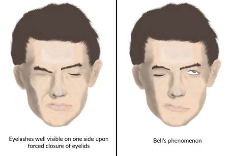 Bell S Palsy Vs Stroke Symptoms Facial Nerve Palsy Knowledge Amboss