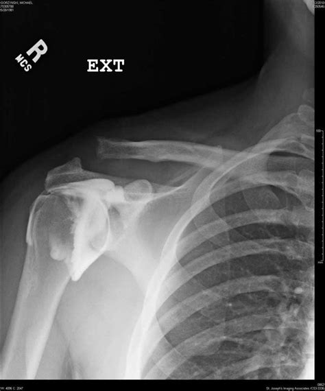 Ac Separation Shoulder Separation