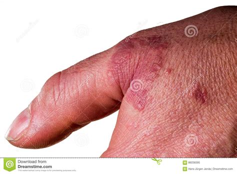 Human Hand With Rash Eczema Stock Image Image Of Whiten Skin 86038395