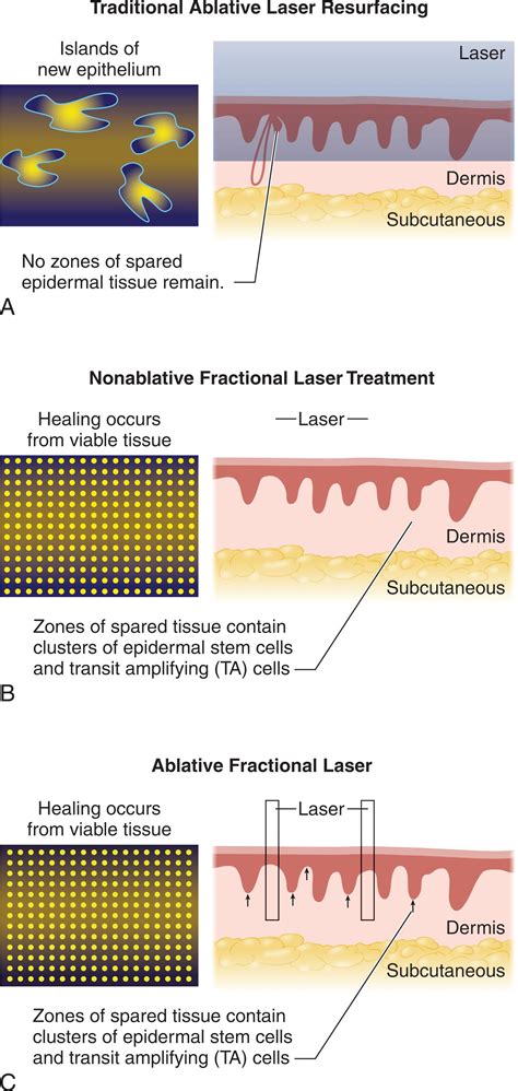 Ablative Laser Skin Resurfacing Clinical Tree