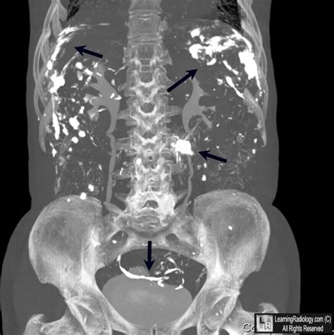 Barium Définition What Is