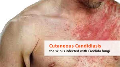 Cutaneous Candidiasis Candida Skin Rash Candida Cure Center