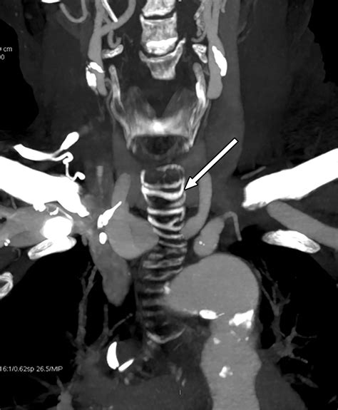 Imaging Evaluation Of Tracheobronchial Injuries Radiographics