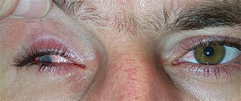 Perforating Injury Caused By Metal Splinter Dalpasso Protesi Oculari