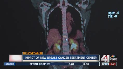 Impact Of New Breast Cancer Treatment Center Youtube