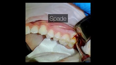 Partial Bony Impaction Wisdom Tooth Removal Video Youtube
