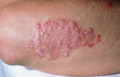 Psoriasis On Elbows