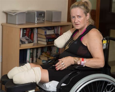Uk Tv Personality Annie Caddis Who Lost Her Legs Below Knee And Arm At