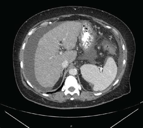 Ct Demonstrating Ascites And Mildly Nodular Liver Surface Contour Oral