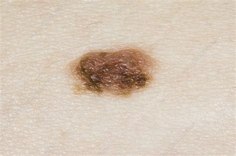 Intradermal Naevus On The Skin Stock Image C0085630 Science