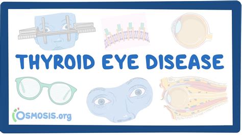 Thyroid Eye Disease Causes Symptoms Diagnosis Treatment Pathology