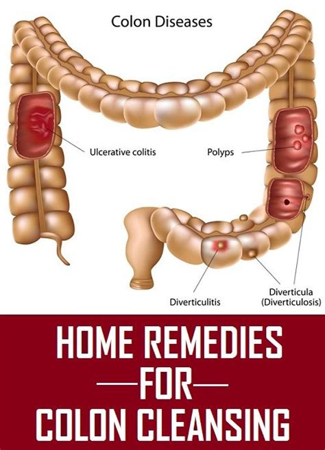 10 Amazing Home Remedies For Colon Cleansing Ulcerative Colitis