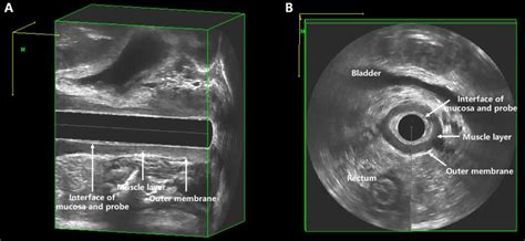 Comparison Between 360° 3 D Transvaginal Ultrasound And Magnetic