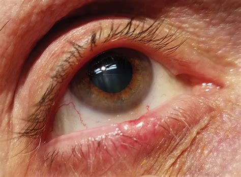 Eyelid Lumps And Bumps Optocase Ph