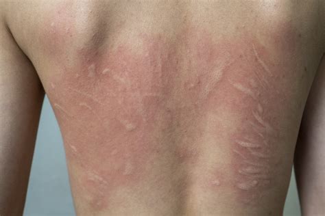 What Are Hives Urticaria