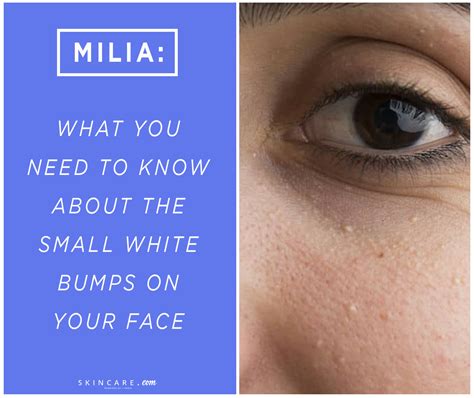 If You Have Tiny White Bumps On Your Face That Are Difficult To Get Rid Of They May Be Milia