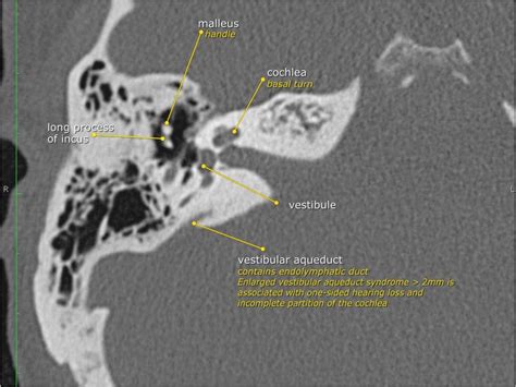 The Radiology Assistant : Temporal bone - Anatomy 2.0 | Temporal bone