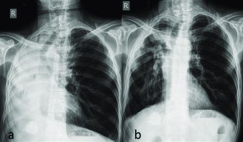 Chest X Ray Showing The Total Atelectasis Of The Left Lung A The Download Scientific Diagram