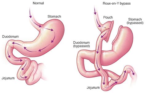 Gastric Bypass Roux En Y Gastric Bypass Indications Side Effects Benefits