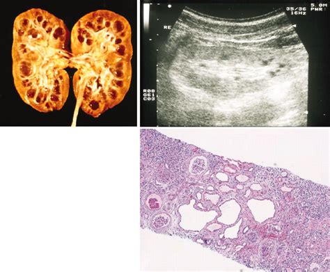 Morphology Of Nephronophthisis A Cysts That Arise From The