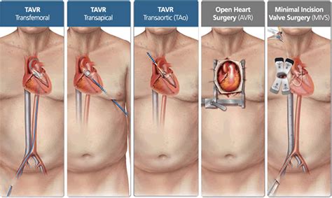 Minimally Invasive Heart Valve Surgery