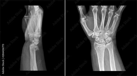 Foto De Film X Ray Wrist Radiograph Show Distal Forearm Bone Broken