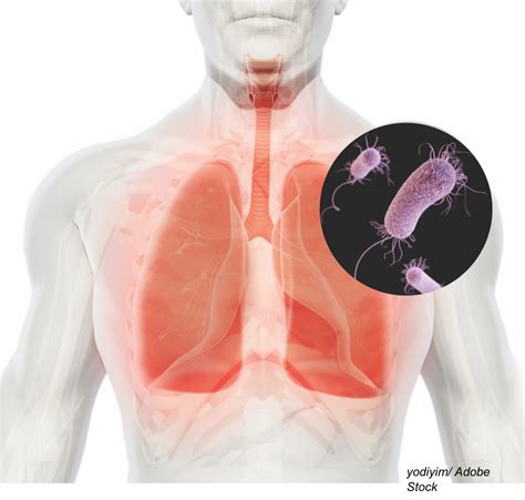 Hospital Acquired And Ventilator Associated Pneumonia Highlights And