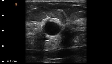 Breast Cysts Scanned W Clarius L7 Scanner By Inside Sales Judy Ward
