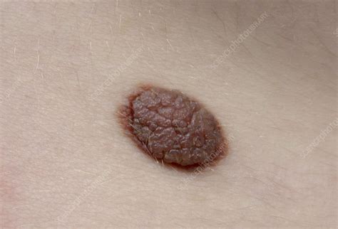Nevus Stock Image C0040532 Science Photo Library