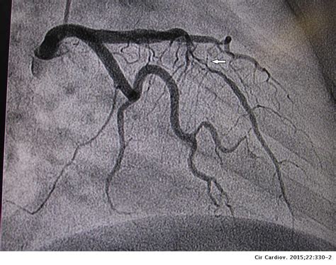 Disección De Arterias Coronarias ¿y Ahora Qué Hago Cirugía