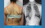 Doctors Who Treat Scoliosis In Adults Pictures