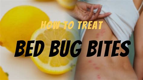 Bed Bug Bite Relief Effective Ways To Treat Bed Bug Bites Remedies And Tips Youtube