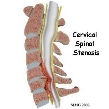 Spinal Stenosis. Causes, symptoms, treatment Spinal Stenosis