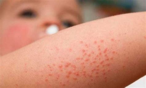 Dermatitis Atópica Un Mal Que Te Puede Acompañar Toda La Vida