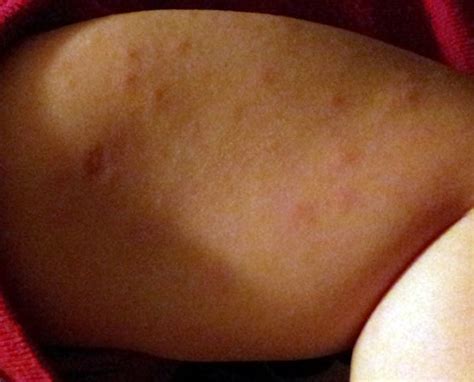 Roseola Rash Images Pictures Photos