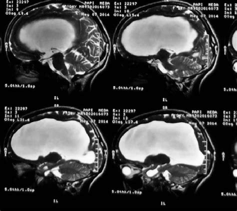 Brain Magnetic Resonance Imaging Demonstrating Enlarged Lateral
