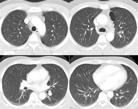 Figure CT Scan COPD Chronic Obstructive StatPearls NCBI