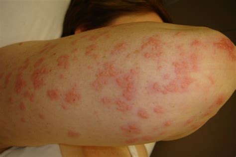 Acd A Z Of Skin Dermatitis Herpetiformis