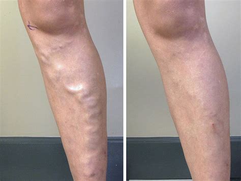 Sclerotherapy Laser Vein Removal Utah Valley Dermatology