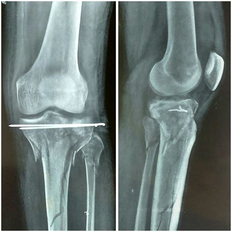 Lateral Tibial Plateau Fracture X Ray