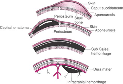 Operative Vaginal Delivery Obgyn Key