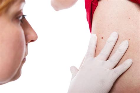 Number Of Moles On Right Arm Could Indicate Melanoma Risk