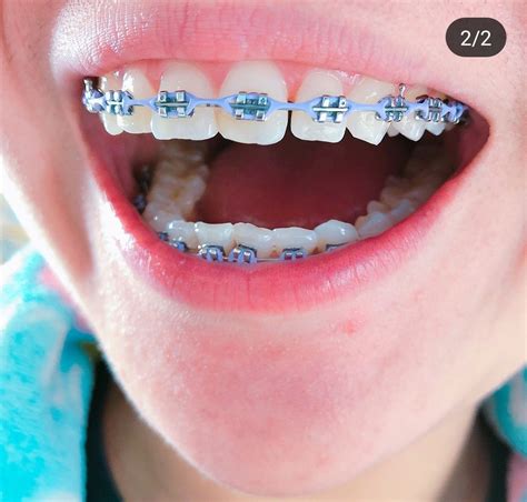 √ Cute Braces Colors