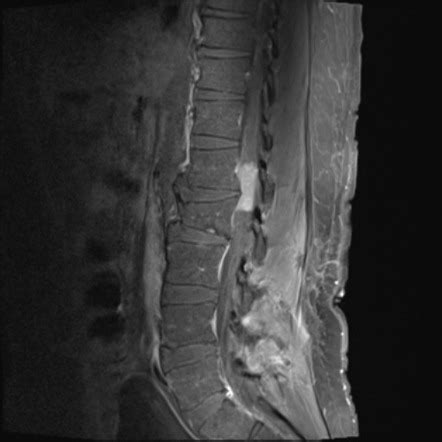 Intradural Extramedullary Spinal Tumors Radiology Reference Article