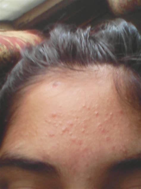 Small Red Forehead Bumps Please Help General Acne Discussion By A