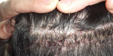 Scabs On Scalp Red Yellow White Causes And Relief Treatment When Itchy